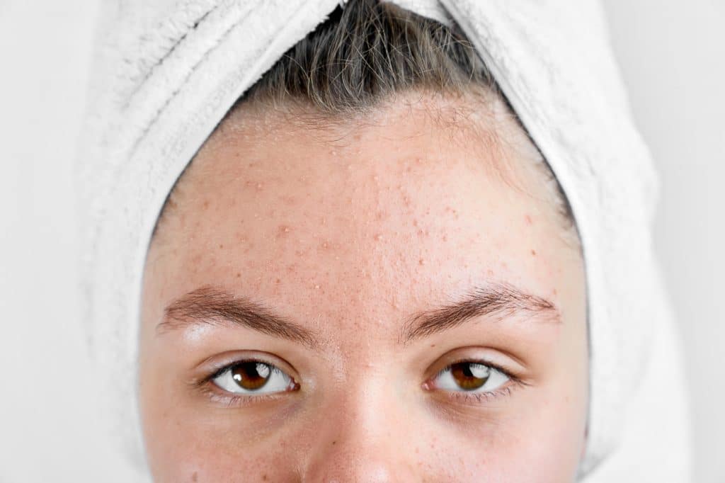 girl after spa white towel with acne problem skin puberty period problem